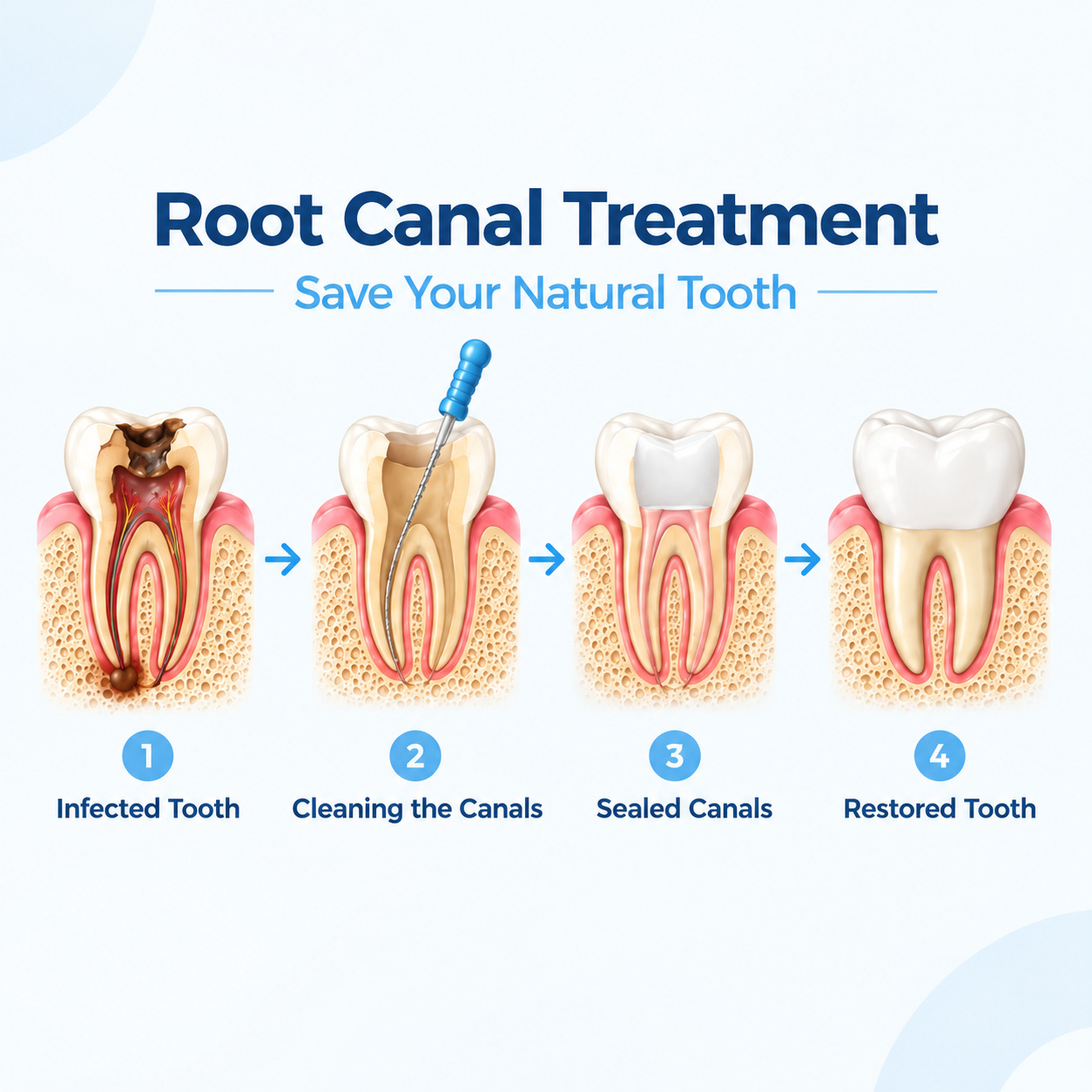 Root Canal Treatment Stages at Dr Ishita Dental Clinic Viman Nagar Pune